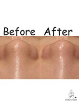 ネムレル森(Nemureru森)/毛穴洗浄【水巻/八幡西区/折尾】