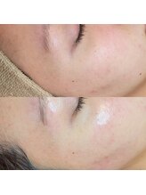 顔肌革命 ビューティアンドヘルス バイ メール(beauty&health by mer)/フェイシャルワックス