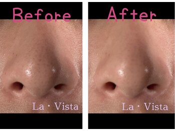 ラ ヴィスタ 川崎店(La Vista)/毛穴洗浄の効果