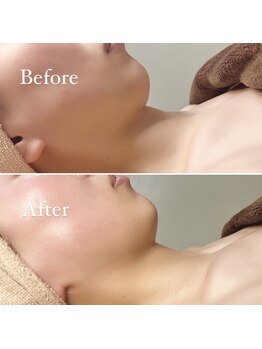 アンシャンテ(ENCHANTER)/小顔フェイシャル