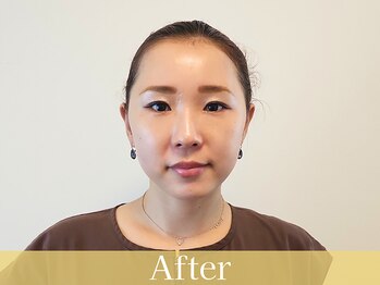 アントルーチェ 代々木上原(Entluce.)/スッキリしたお顔で小顔に