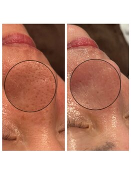 リフロ(Rifuro)/毛穴のひらきも一度でここまで