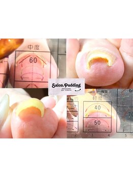 爪の悩みを解消できる（ケア含む）