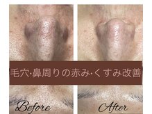 フリージア(Beauty Salon Freesia )/美肌菌活ピールで毛穴ケア