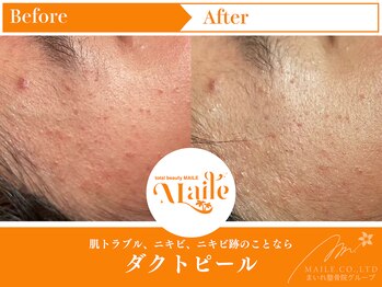 まいれ鍼灸院整骨院 整体院 草津院/ダクトピール/赤み/ニキビ