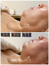 オージャス(OJAS)/40代/ 【小顔フェイシャル】