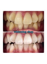 ホワイトニングショップ 所沢店/before&after美白ホワイトニング