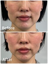 ハリキュア(Hari-Cure)/美容鍼Before After