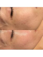 アンバー(amber)/目元の小さなシミ改善にもハーブ