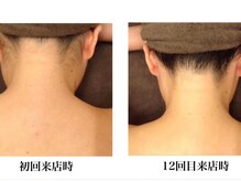 フフラバイプラス(FUFLA BY PLUS)/うなじ脱毛