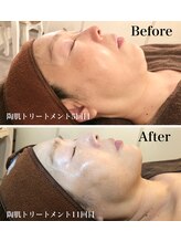 ポードジェーン(peau de jeune)/REVIハーブピーリング5回