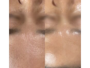 キャンディサロンの写真/ぷるぷるの憧れ水光肌へ♪お肌の内側へ潤いやコラーゲンを与えて貯め込み、乾燥・シワ・たるみをケア◎