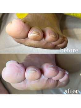 ドクターネイル爪革命 札幌本店/症例紹介21 たこ