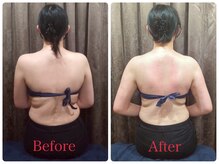 ハリーナ(HARI-NA)/ラジオ波を使ってむくみ改善