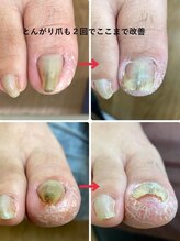 一宮巻き爪センター/とんがり爪