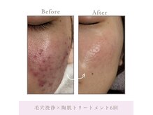 群馬/肌質改善/ハーブピーリング/毛穴洗浄/毛穴ケア/ヘッドスパ