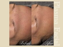 ミリュール(Millule)/1回の効果　おでこの小じわ