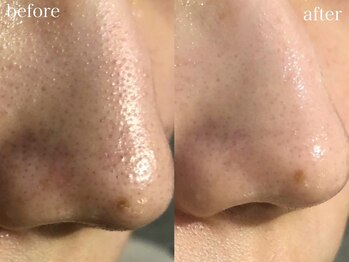 アワピール 天王寺店(AWA PEELL)/毛穴洗浄/天王寺/毛穴洗浄/小顔