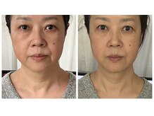 サロン オリ(salon_oli)の雰囲気（輪郭リフト『お顔の骨からリフトアップ』若見え効果絶大！）