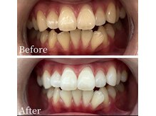 ウルル(Ululu)/ホワイトニング