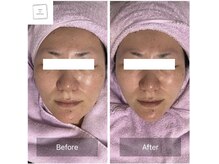 サロン ド パーフェクション(Salon de Perfection)/小顔リフト