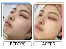 ストラッシュ 豊田店(STLASSH)/施術例：顔（フェイシャル）