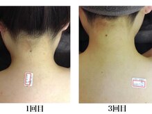 フフラバイプラス(FUFLA BY PLUS)/うなじ脱毛