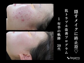 レガロビューティクリエイションズ桜川店/ニキビケア！肌質改善プログラム