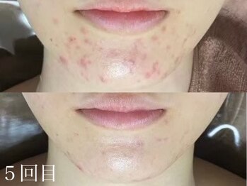 ホワイトアクア 天王寺本店(WHITE AQUA)/ハーブピーリング/毛穴/天王寺