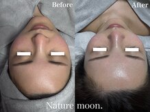 ナチュールムーン(Nature moon.)/ハーブピーリング