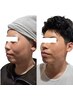 【二重顎・フェイスライン・お顔の脂肪に】整顔リフトUP60分¥6200→4200