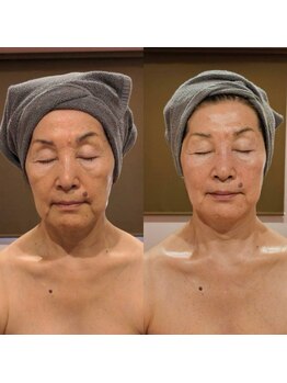 ルクス 富士宮店(Lux)の写真/【内側から押し返すような弾力肌へ♪】高濃度ビタミン導入で目指す極上ハリツヤ美肌