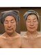 ルクス 富士宮店(Lux)の写真/【内側から押し返すような弾力肌へ♪】高濃度ビタミン導入で目指す極上ハリツヤ美肌