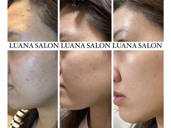ルアナサロン(LUANA SALON)/肌質改善