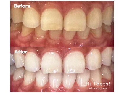 ハイティース 高田馬場店(Hi Teeth!)の写真
