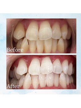 ホワイト 福岡天神店(WHITE)/ホワイトニングビフォーアフター