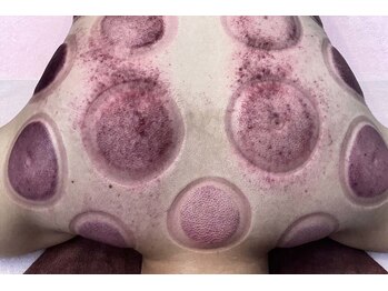 スイクウ ネオ(neo)/カッピング跡