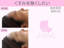 ぷるるんエステ/毛穴/小顔/フェイシャル