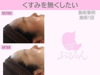 ぷるるんエステ/毛穴/小顔/フェイシャル