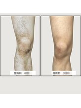 ル ボヌール/最新IPL　ｊ光脱毛