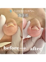 名古屋巻き爪専門Pro/親指以外の巻き爪補正