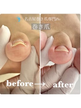 名古屋巻き爪専門Pro/親指以外の巻き爪補正