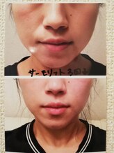 トータルビューティー 美沙妃 葛西店/サーモ3回施術before→after