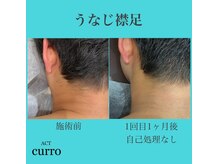 アクト クロ(ACT curro)/【うなじ襟足】脱毛施術例