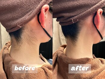 ブロートーキョー 有楽町店(BroTokyo)/襟足シェービング&脱毛