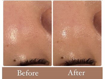 サロンドフェイス 木曽川店(Salon de Faith)/毛穴改善♪