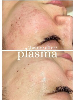 ビー ブルーム(B BLOOM)/【プラズマシャワー】肌質改善