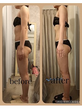 リープ(Lieb)/ボディビフォーアフターラジオ波