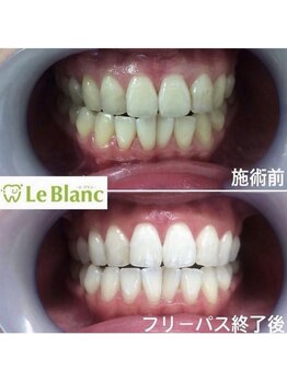 ルブラン 奈良店(Le Blanc)/回数を重ねるごとにトーンアップ