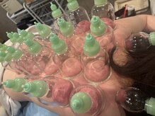 骨気(コルギ)専門店 YONG miu【ヨング ミュー】/カッピング【首肩こり】